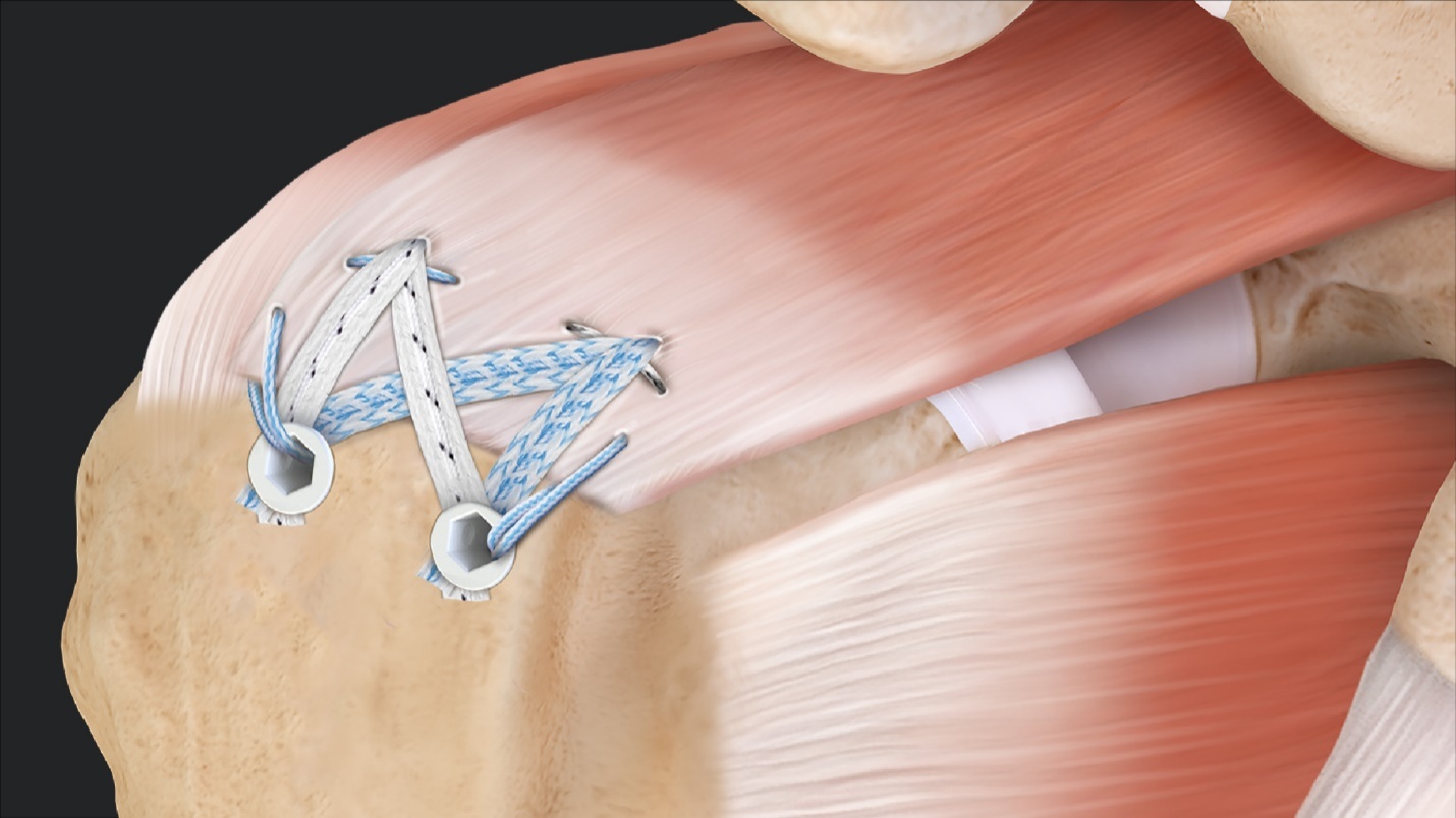 Arthrex - SpeedBridge™ Rotator Cuff Repair With Medial Ripstop Sutures and  Knotless SwiveLock® Anchor