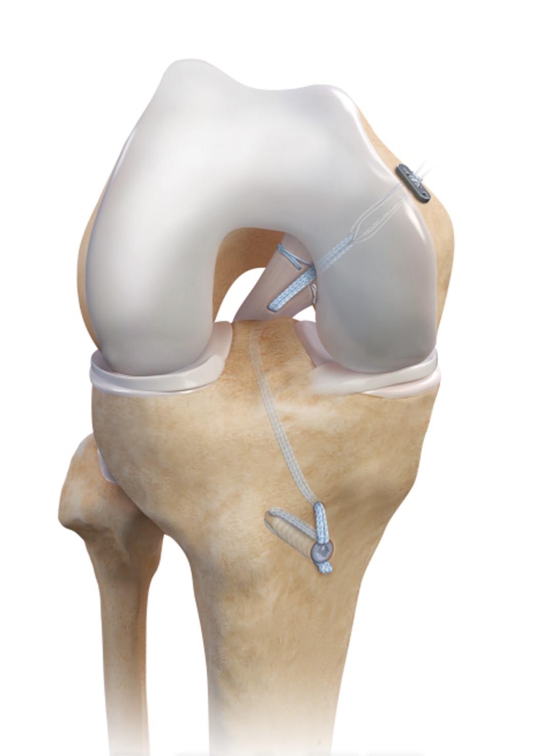 Cureus | Posterior Cruciate Ligament Repair With Suture Augmentation: A Report of Two Cases With Two-Year Follow-Up