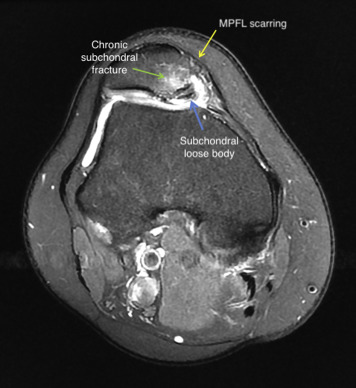 Double-Bundle Medial Patellofemoral Ligament Reconstruction With Allograft  - Arthroscopy Techniques