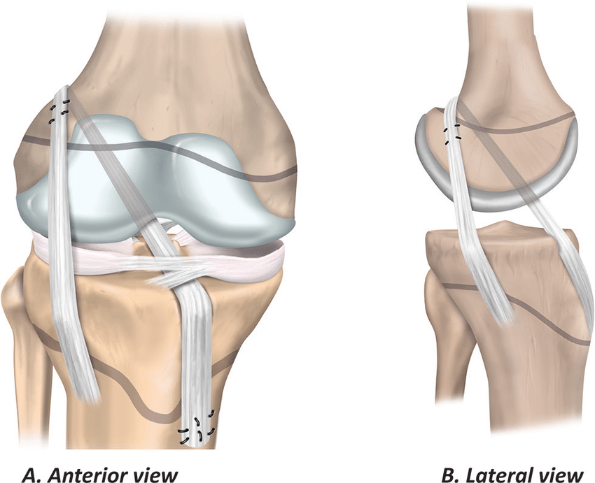 Physeal-sparing ACL reconstruction using an over-the-top technique with iliotibial band. (A) Anterior view and (B) lateral view. 
