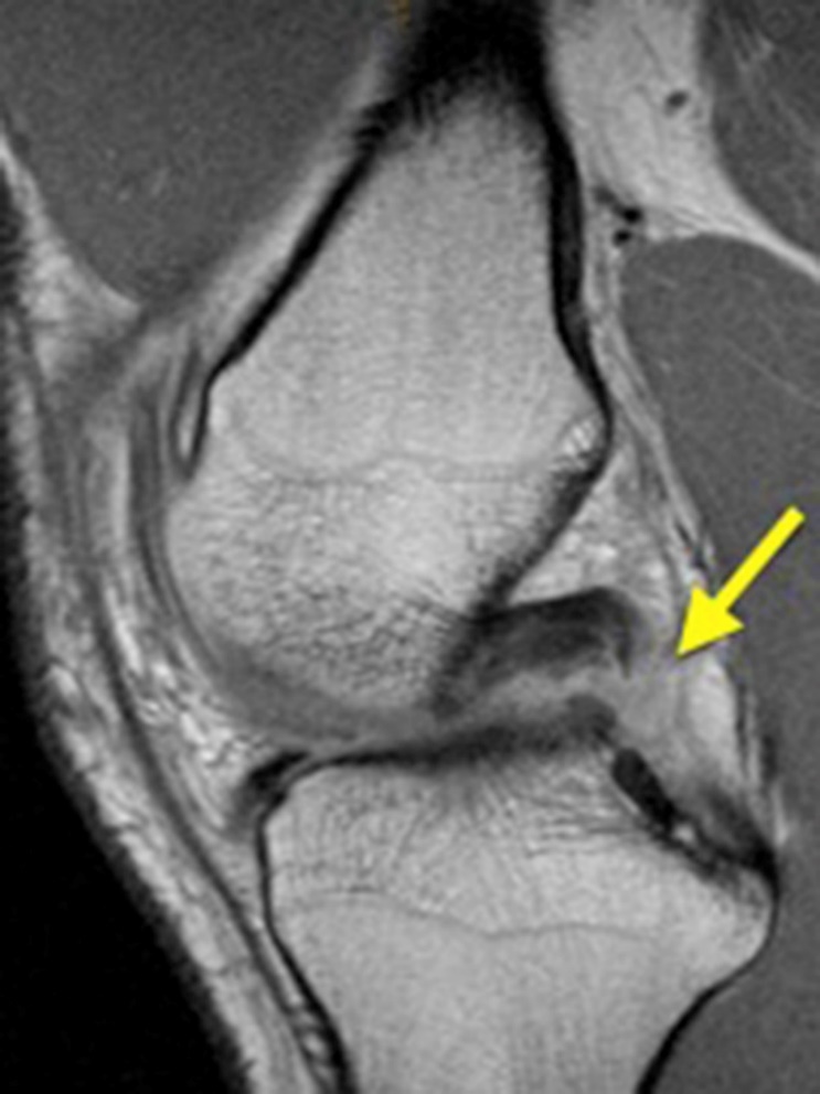 Posterior Cruciate Ligament Injuries of the Knee at the National Football League Combine: An Imaging and Epidemiology Study - Arthroscopy