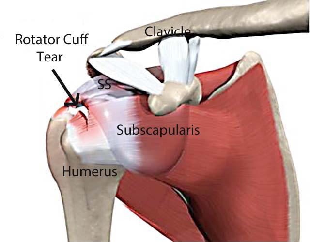 Rotator Cuff Tears and Repairs: Midwest Center for Joint Replacement: Hip  and Knee Replacement Surgeons