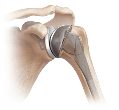 When Reverse Total Shoulder Arthroplasty Is Used ? | Stability of Shoulder  Arthroplasty