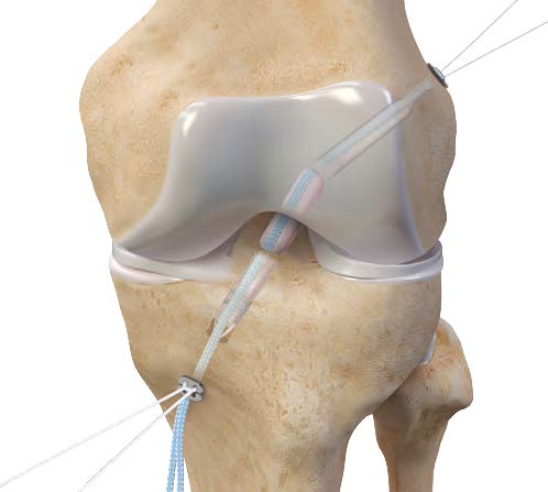 ACL Injury (Adults)