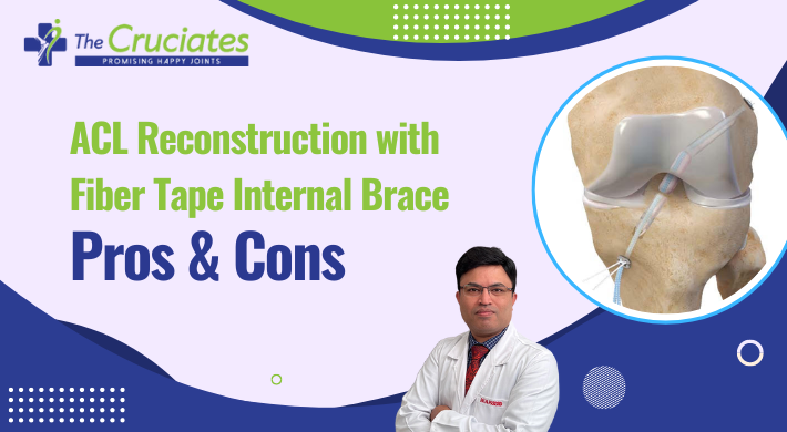 ACL Reconstruction With Fiber Tape Internal Brace Pros & Cons