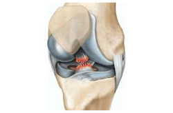ACL Injury Adults