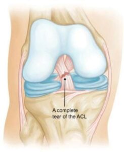 A complete Tear Of ACL