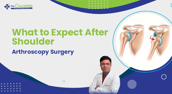 What to Expect After Shoulder Arthroscopy Surgery