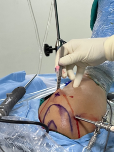 Indications For Shoulder Arthroscopy Surgery- TheCruciates