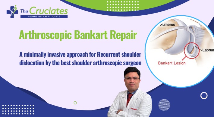 Arthroscopic Bankart Repair: A minimally invasive approach for Recurrent shoulder dislocation by the best shoulder arthroscopic surgeon.