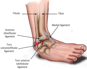 FMPA - How To Rehab An ATFL Ankle Injury In Football With Empowerband