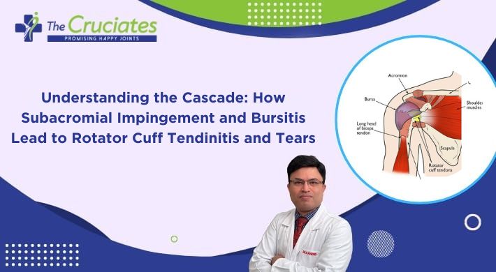 Understanding the Cascade: How Subacromial Impingement and Bursitis Lead to Rotator Cuff Tendinitis and Tears